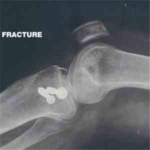 Fracture  - Fracture