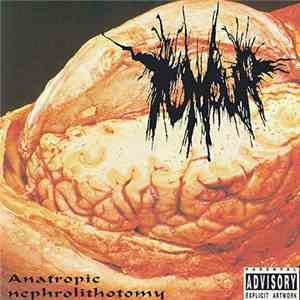 Tumour - Anatropic Nephrolithotomy